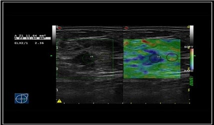 E80 diagnóstico mamario