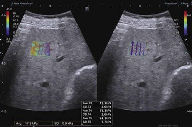 Elastografía Shear Wav3