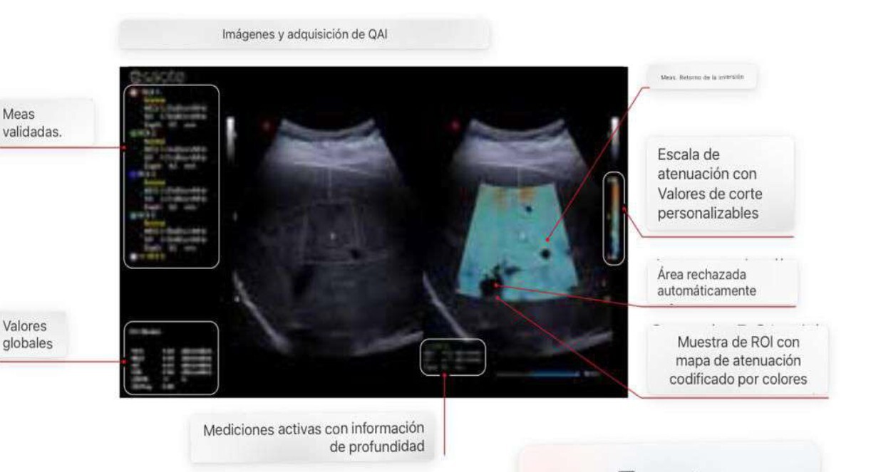 esteatosis con QAI