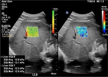 Shear Wave Elastography