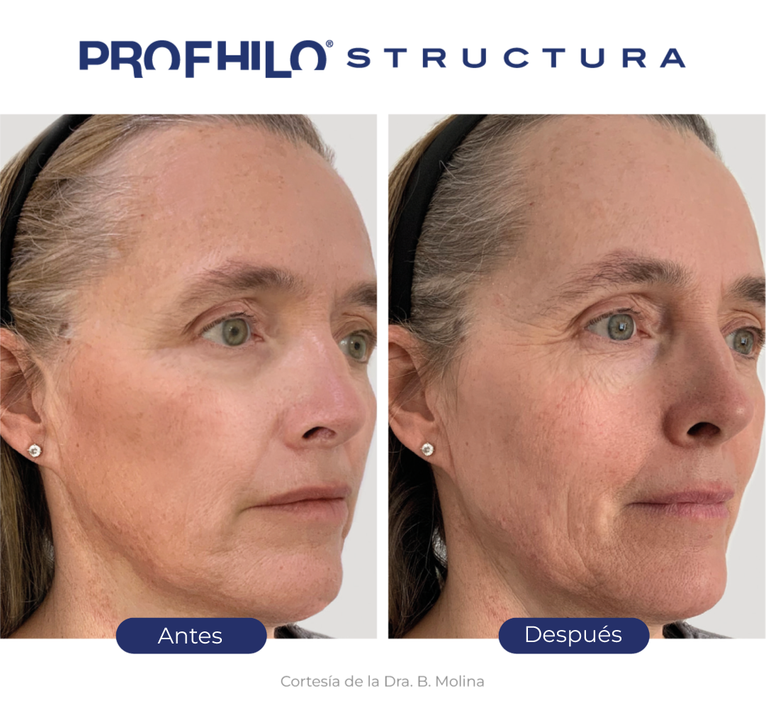Antes y después Profhilo Structura