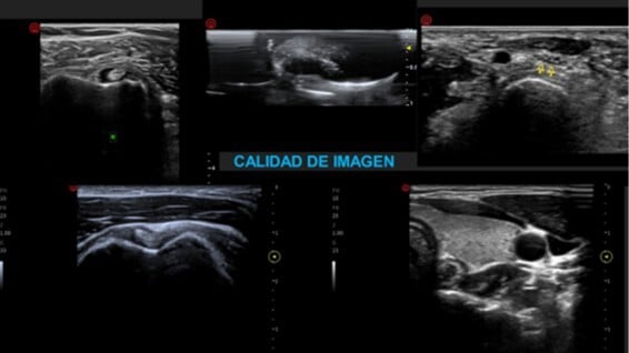 ecógrafo portatil para estudios vasculares